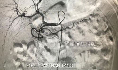 Benh nhi 11 tuoi nguy kich do viem tuy cap von pho bien o nguoi lon