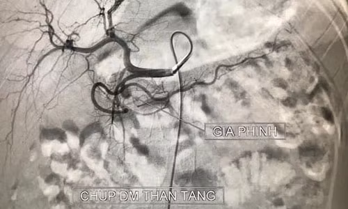 Benh nhi 11 tuoi nguy kich do viem tuy cap von pho bien o nguoi lon