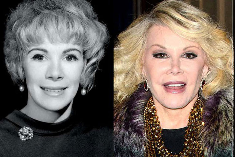 Để níu giữ vẻ thanh xuân, cố diễn viên Joan Rivers nhiều lần phẫu thuật thẩm mỹ. Vì ham hố dao kéo, cô có chiếc mũi nhọn hoắt, biến dạng. Ảnh: VOV