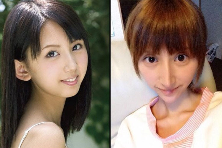 Nữ ca sĩ người Nhật Nanase Rina nâng và kéo mũi. Do phẫu thuật hỏng, chiếc mũi của cô to nhọn, không hài hòa với tổng thể gương mặt. Ảnh: Zing