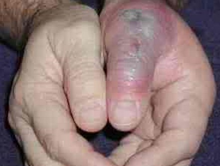 Trong trường hợp vết thương không được chữa trị một cách triệt để có thể dẫn đến nhiễm trùng và phải cắt bỏ hoặc nặng hơn có thể gây tử vong. Ảnh: CSW.