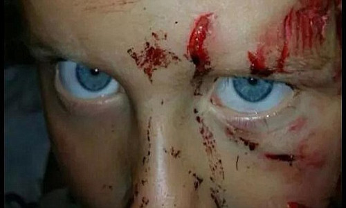 Be 5 tuoi bi thuong nang vi cho tan cong