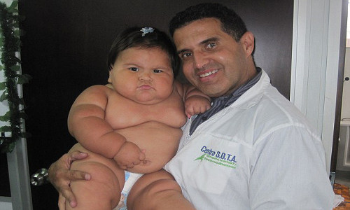 Ông Fry cho biết có nhiều yếu tố khác nhau gây ra bệnh béo phì ở trẻ trong số đó có hội chứng Prader-Willi. Người mắc hội chứng này muốn ăn liên tục và dễ dàng tăng cân khó kiểm soát.