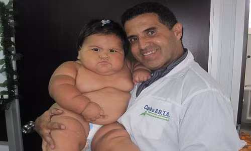 Ông Fry cho biết có nhiều yếu tố khác nhau gây ra bệnh béo phì ở trẻ trong số đó có hội chứng Prader-Willi. Người mắc hội chứng này muốn ăn liên tục và dễ dàng tăng cân khó kiểm soát.