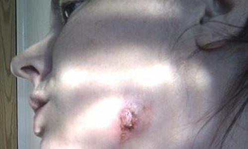 Kinh hai co gai bi chay mu tren ma sau khi dieu tri ap xe rang