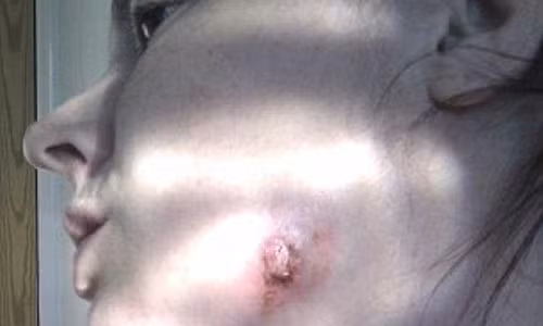 Kinh hai co gai bi chay mu tren ma sau khi dieu tri ap xe rang