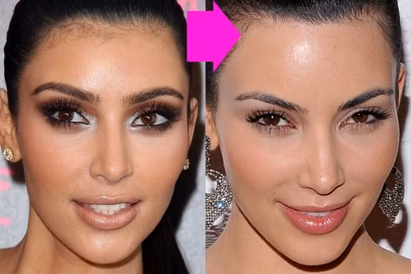 Nhiều người đánh giá, độn trán không chỉ cải thiện hình dáng trán mà còn làm nổi bật các đường nét vùng sống mũi, giúp khuôn mặt trông thon gọn và dễ nhìn hơn. Những vấn đề như trán thấp, trán ngắn do bị tóc che phủ không còn là nỗi lo của chị em, khuôn mặt bạn sẽ trở nên cân đối, thanh tú nhờ có đường S-line nối từ trán đến mũi.