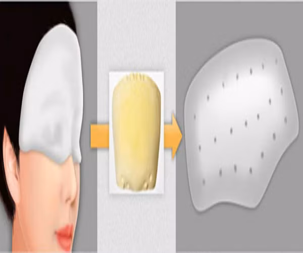 Ngoài phương pháp sử dụng vật liệu độn silicone, kỹ thuật tạo hình trán còn có thể sử dụng mỡ tự thân, tiến hành cấy từ trán tới phần lông mày, không có đường mổ, cũng không có sẹo ở da đầu. Các vùng lõm trên trán được khắc phục, làm đầy đặn.