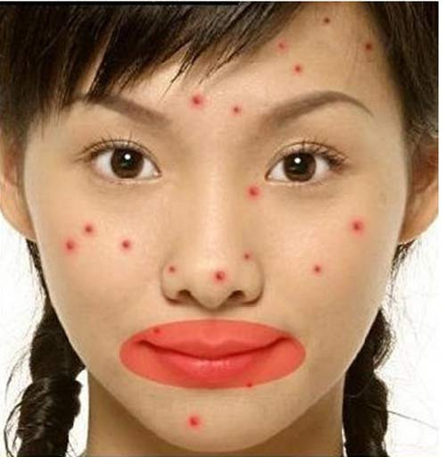 Mụn mọc khu vực quanh môi hoặc vai. Liên quan đến vấn đề tiêu hóa. Tỳ có nhiệm vụ hấp thu dinh dưỡng, Vị tiếp nhận thức ăn. Tỳ và vị hợp tác với nhau để hấp thu thức ăn và chuyển vận chất dinh dưỡng. Do đó, việc bài trừ độc tố ở tỳ là rất quan trọng.