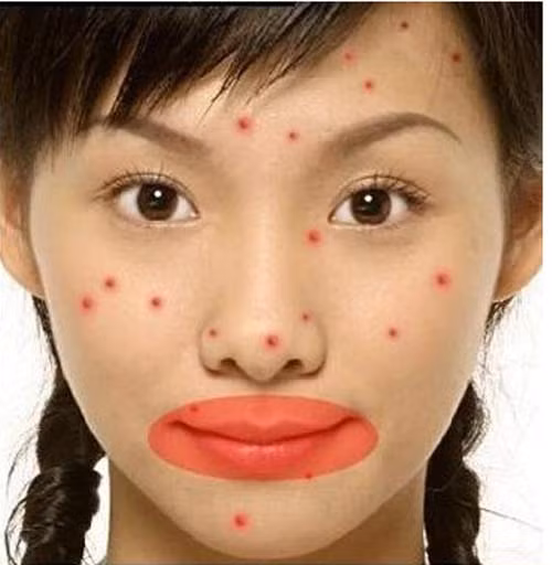 Mụn mọc khu vực quanh môi hoặc vai. Liên quan đến vấn đề tiêu hóa. Tỳ có nhiệm vụ hấp thu dinh dưỡng, Vị tiếp nhận thức ăn. Tỳ và vị hợp tác với nhau để hấp thu thức ăn và chuyển vận chất dinh dưỡng. Do đó, việc bài trừ độc tố ở tỳ là rất quan trọng.