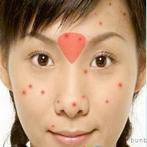 Mụn mọc ở giữa lông mày. Có thể gan của bạn đang phải làm việc quá tải với độc tố trong cơ thể. Hãy cắt bớt đường, sữa, chất béo trong thực đơn hàng ngày, đặc biệt nói không với những chất cồn như rượu, bia nhé.