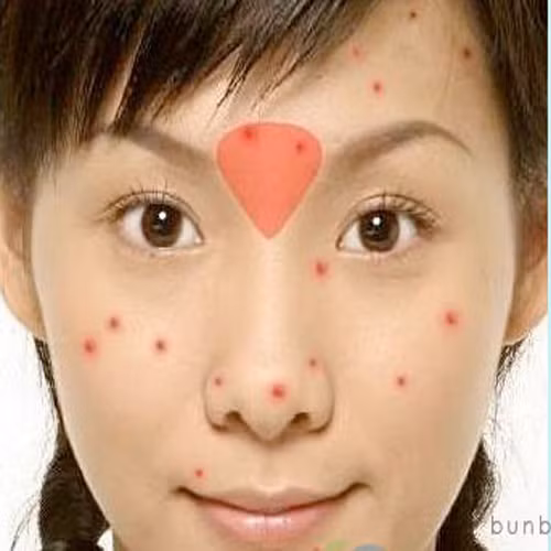 Mụn mọc ở giữa lông mày. Có thể gan của bạn đang phải làm việc quá tải với độc tố trong cơ thể. Hãy cắt bớt đường, sữa, chất béo trong thực đơn hàng ngày, đặc biệt nói không với những chất cồn như rượu, bia nhé.