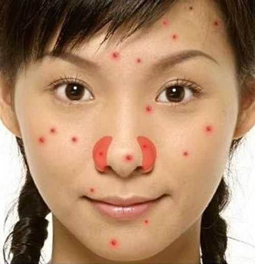 Mụn mọc ở cánh mũi. Xuất hiện những em mụn trứng cá ở vị trí này có thể bắt nguồn từ sự thay đổi trong hệ thống sinh sản hay buồng trứng. Cũng có thể bạn gặp vấn đề với hệ thống tim mạch, tim bạn thiếu protein hay vitamin B do đó tuần hoàn máu kém gây mụn. Hãy giải quyết chúng bằng cách hạn chế thực phẩm cay, thịt và ăn những thực phẩm ấm vừa đủ, thêm nữa là massage khu vực mũi để làm lặn mụn.