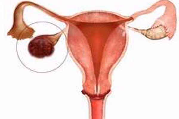 Điều này có nghĩa phụ nữ mắc lạc nội mạc tử cung có thể có nhiều thời gian hơn trước khi cố gắng thụ thai vì những thiệt hại đường sinh sản được giảm đi rất nhiều. Những phụ nữ dùng thuốc tránh thai, đặt vòng hay những biện pháp ngừa thai khác từ 15 năm trở lên có thể giảm nguy cơ phát triển bệnh ung thư buồng trứng và ung thư nội mạc tử cung tới gần 50%.