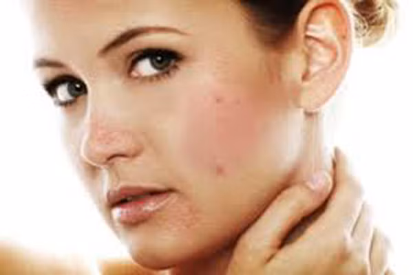 Mụn mọc ở má. Mụn xuất hiện trên má phải là dấu hiệu cho thấy phổi của bạn không khỏe. Nếu bạn bị hen suyễn hoặc là một người hút thuốc, các mao mạch nhỏ dưới da của bạn dễ bị phá vỡ, tạo nên mụn. Mụn mọc trên má phải cũng có thể xảy ra khi bạn mắc các bệnh đường hô hấp. Trong trường hợp này hãy ăn nhiều thực phẩm nhuận phổi như rau mầm, bí ngô, cải xoăn và vệ sinh chăn gối sạch sẽ.