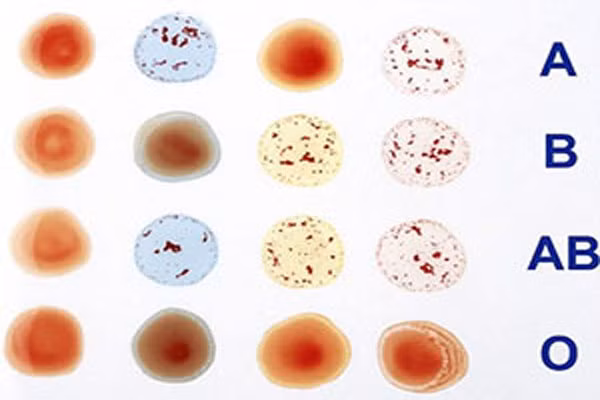 Mới đây, một nghiên cứu khoa học đã hé lộ những bí mật về dự đoán tuổi thọ theo các nhóm máu. Những người có nhóm máu là A, B hoặc AB có nguy cơ mắc bệnh tim và cuộc sống ngắn hơn so với những người có nhóm máu O.