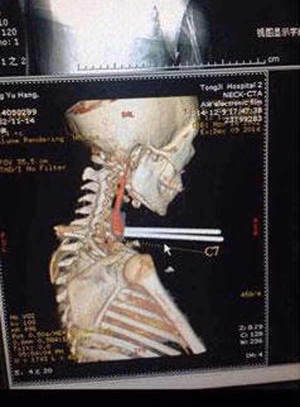 Cậu bé 12 tuổi Chia Jun sống tại Trung Quốc, tranh thủ giờ ra chơi đã chạy ra căng tin của trường mua 1 hộp mỳ ăn liền. Không may, chiếc xe máy điện của 1 phụ huynh trong lớp đi trên sân trường đã lao đến đâm ngã cậu bé làm đôi đũa chọc thẳng vào họng của Chia. các ảnh chụp X-quang cho thấy, đôi đũa tuy xuyên thủng sâu vào cổ họng cậu bé nhưng lại không gây ra nguy hiểm gì đến tính mạng của Chia Jun.