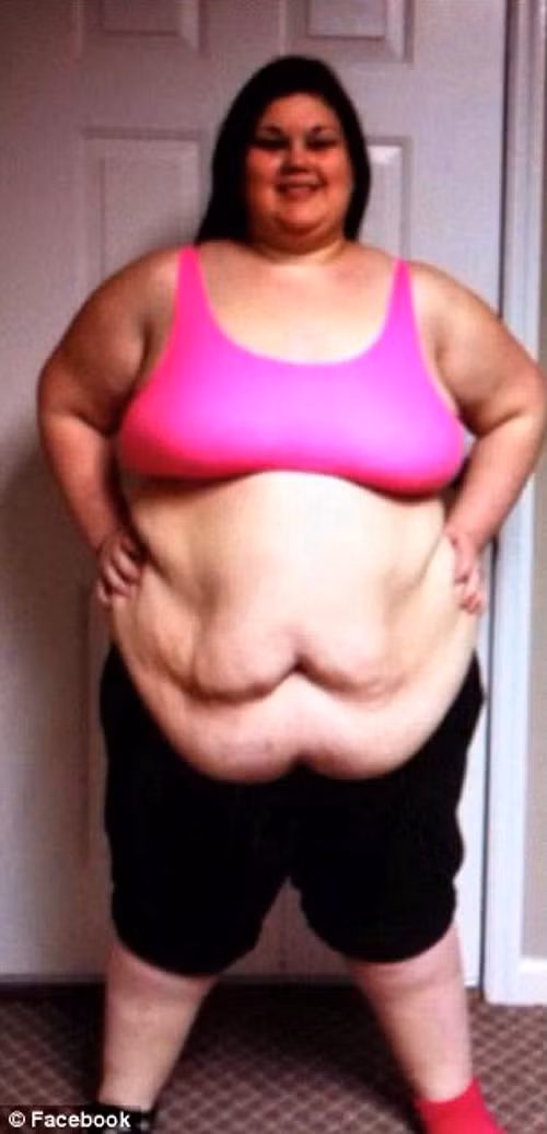 Phai phau thuat cat da thua vi giam can gan 100kg-Hinh-5