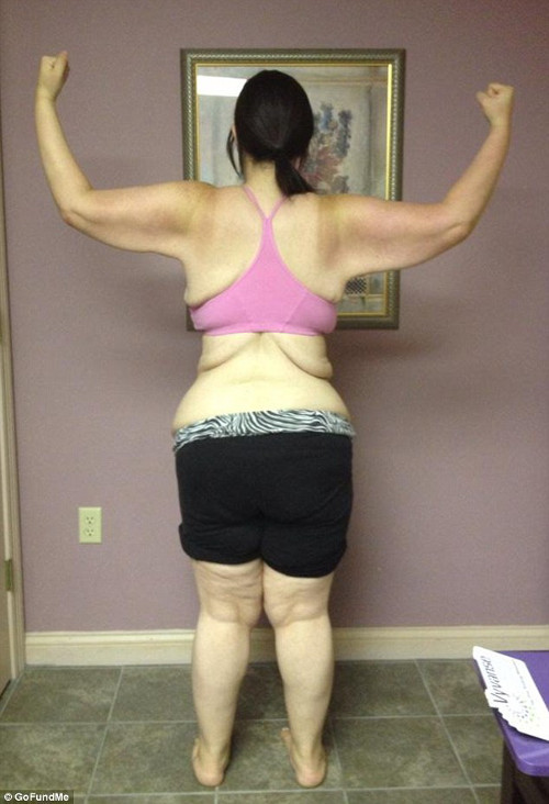 Hiện tại, Kaitlyn Smith dự định trải qua một loạt ca phẫu thuật để loại bỏ phần da thừa trên cơ thể. Cô sẽ phải bỏ ra khoảng hơn 1 tỷ để phẫu thuật thẩm mỹ cắt bỏ da thừa trên hai tay, chân, bụng và lưng.