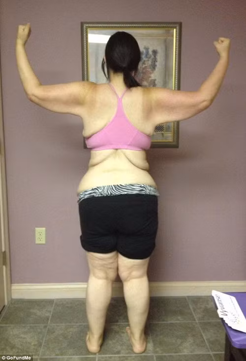 Phai phau thuat cat da thua vi giam can gan 100kg-Hinh-3