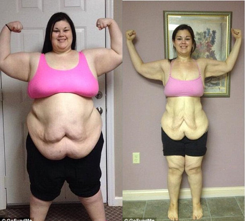 Vài năm trước đây, Kaitlyn Smith, 19 tuổi, đến từ Portland, Oregon, rất sợ đi ngoài vì thân hình quá béo của mình, 190kg. Tưởng như cô phải phẫu thuật dạ dày để giảm cân, thì một huấn luyện viên y tế đã giúp cô giảm được 94kg bằng chế độ ăn uống và tập thể dục.