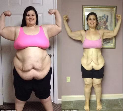 Phai phau thuat cat da thua vi giam can gan 100kg