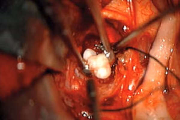 Can canh benh tat tan pha co the du doi