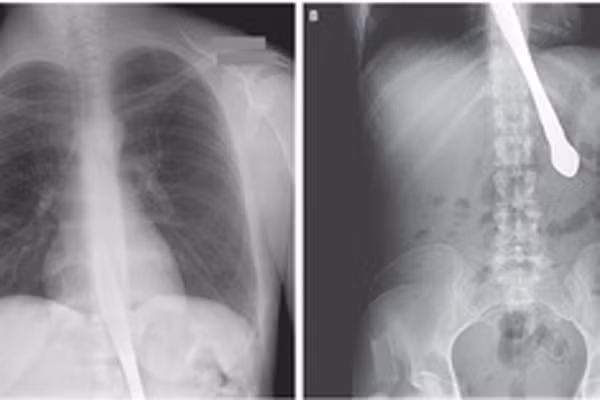 Anh Andrew Linn 28 tuổi tại Las Vegas Andrew, đã gặp phải vụ tai nạn có một không hai khi đang lái xe trong tình trạng buồn ngủ. Linn đã lao xe ra khỏi hướng đang lưu thông trước khi đâm phải hàng rào bằng kim loại. Các nhân viên cứu hộ đã phải cắt ống kim loại để đưa tài xế ra khỏi xe và chuyển khẩn cấp tới bệnh viện. Đội ngũ y tế tại đã có thể loại bỏ ống kim loại mà không gây hại đến động mạch cảnh và tĩnh mạch cổ.