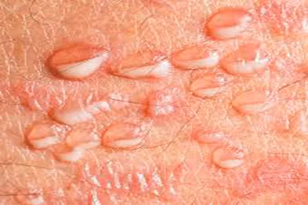 Hình ảnh này được chụp lại trên da của người đàn ông 66 tuổi tại Anh. Sau khi làm xét nghiệm sinh thiết, ông được chẩn đoán mắc tình trạng mụn mủ da liễu subcorneal. Tình trạng này gây ra do tác dụng phụ của thuốc.