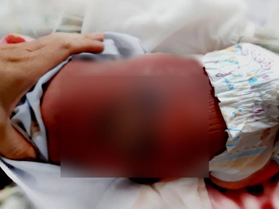 Be so sinh bi bong nang, nhiem trung mau do suoi than