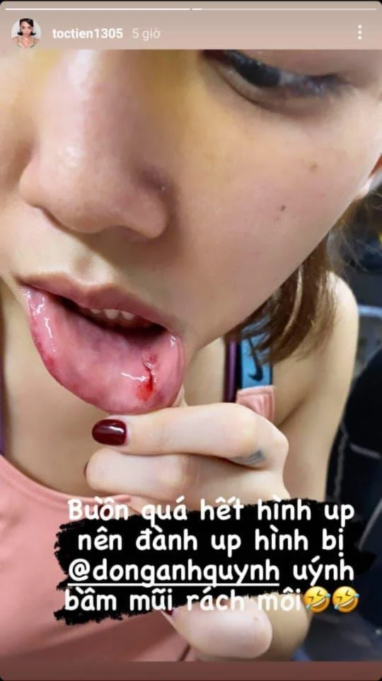 Tóc Tiên bị Đồng Ánh Quỳnh đánh đến mức bầm mũi, rách môi Toc Tien bi Dong Anh Quynh danh den muc bam mui, rach moi