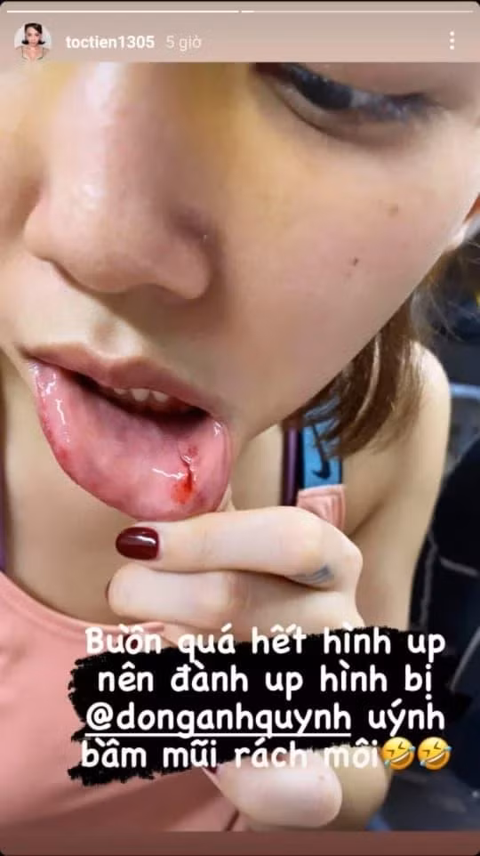 Tóc Tiên bị Đồng Ánh Quỳnh đánh đến mức bầm mũi, rách môi Toc Tien bi Dong Anh Quynh danh den muc bam mui, rach moi