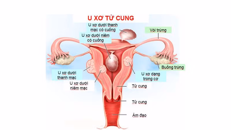 U xơ cổ tử cung: Nhiều chị em có quan niệm, đêm khuya dễ tập trung vào công việc, tình trạng này kéo dài sẽ là một mối nguy hại lớn. Cùng với việc giảm béo bừa bãi, khiến quá trình bài tiết hoóc-môn trong cơ thể bị rối loạn. Đó chính là nguyên nhân quan trọng dẫn đến chứng u xơ cổ tử cung. Ảnh: ginethealthcare