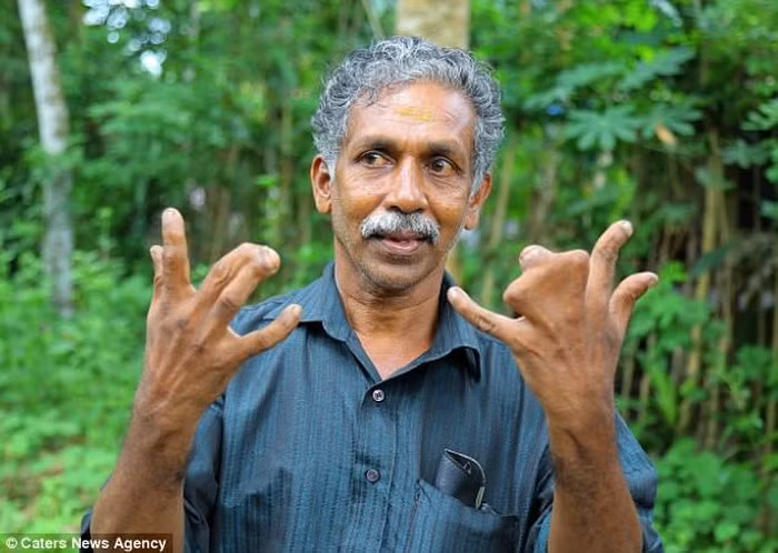 Một thành viên lớn tuổi trong gia đình nói rằng, “mặc dù các ngón tay dị tật nhưng chúng tôi sẽ không phẫu thuật. Chúng tôi sinh hoạt bình thường, chẳng hề gặp khó khăn gì”. Họ có thể nấu ăn, thái rau, giặt quần áo, sửa chữa nhà cửa mà chẳng bao giờ gặp rắc rối gì.