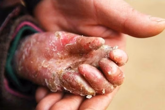 Cậu bé ở Trung Quốc cũng vậy, mắc chứng ly thượng bì bóng nước bẩm sinh khiến cơ thể lở loét. Lớp da của cậu bé chỉ mỏng như cánh bướm và những bóng nước sẽ xuất hiện sau va chạm nhẹ. Bóng nước phồng rộp khiến lớp da lột liên tục. Mẹ của cậu luôn phải thay ga giường hàng ngày do máu và mủ chảy ra từ vết thương của con mình. Ảnh: Sina.