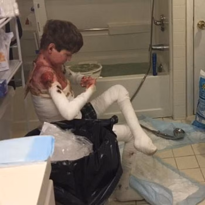 Cậu bé đã mất 60-70% da trên cơ thể, John hầu như không thể đi lại. Cuộc sống của em dựa vào thuốc giảm đau cả đời và bồn tắm lúc nào cũng có dấm và Clorox để đề phòng nhiễm trùng. Ảnh: Khoe356.