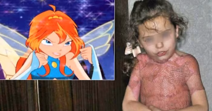 Dù may mắn được cứu sống nhưng cô bé 5 tuổi này phải gánh chịu những đau đớn và thương tổn đến từ những vết bỏng suốt cả cuộc đời.