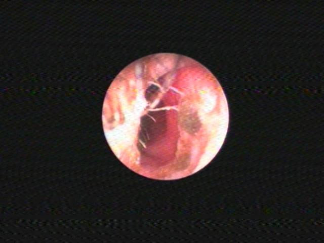 Chảy nước mũi suốt 2 tháng vì thun cột tóc kẹt trong hốc mũi Chay nuoc mui suot 2 thang vi thun cot toc ket trong hoc mui