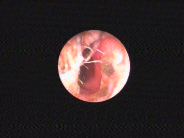 Chay nuoc mui suot 2 thang vi thun cot toc ket trong hoc mui