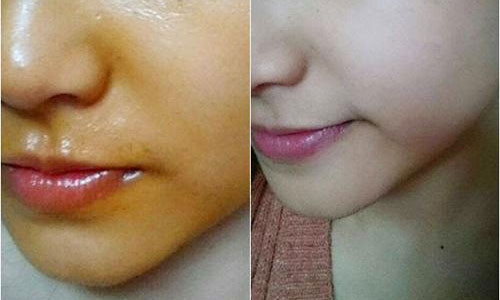 Lưu lại dầu gấc trên mặt qua đêm, sáng hôm sau rửa sạch lại bằng nước.