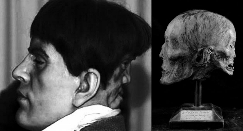 Ông đã gọi khuôn mặt thứ hai của mình là khuôn mặt của quỷ. Edward Mordrake tự sát năm 23 tuổi sau khi các bác sĩ từ chối làm phẫu thuật tách khuôn mặt thứ hai khỏi đầu ông.