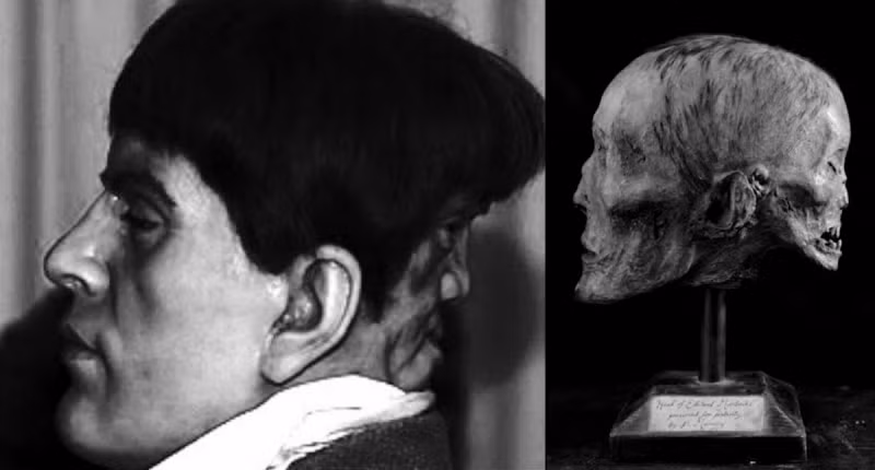 Ông đã gọi khuôn mặt thứ hai của mình là khuôn mặt của quỷ. Edward Mordrake tự sát năm 23 tuổi sau khi các bác sĩ từ chối làm phẫu thuật tách khuôn mặt thứ hai khỏi đầu ông.