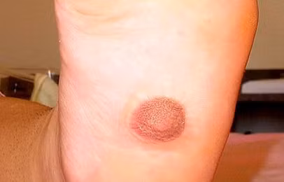 Cô Allen cho biết, núm vú đó không làm cô bị đau. Hầu hết các trường hợp mọc núm vú hoặc u sợi tuyến đều xuất hiện ở đường truyền sữa, có thể ở lưng, đùi, mặt, nhưng bàn chân thì chưa từng thấy.