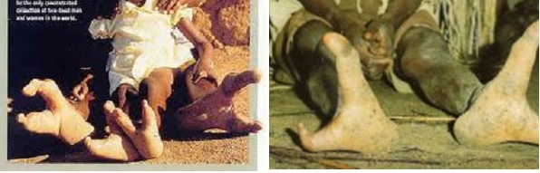 Tỷ lệ này sẽ giảm đi đáng kể nếu những người có đôi bàn chân kỳ lạ này được kết hôn với người ngoại tộc.