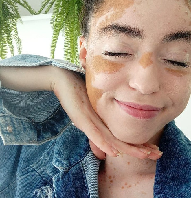  Stephanie Muro Yashimura (28 tuổi) là người mẫu, influencer đến từ São Paulo, Brazil. Từ năm 14 tuổi, cô phát hiện mắc chứng bệnh bạch biến, tình trạng làm suy giảm sắc tố melanin trên da và gây ra các đốm trắng trên khắp cơ thể và rất khó điều trị. Sau 14 năm, Stephanie đã vượt qua được giai đoạn khó khăn để chấp nhận khiếm khuyết của bản thân và sống tích cực hơn.