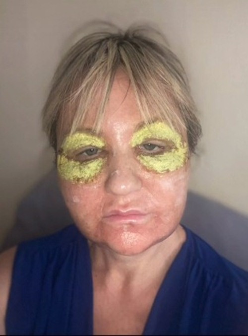 Sau khi tham khảo ý kiến của bác sĩ phẫu thuật thẩm mỹ, cô Amanda đã quyết định chi 1800 bảng Anh cho một liệu pháp điều trị nếp nhăn khá đau đớn.