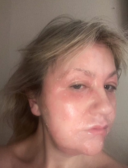 Amanda chia sẻ quá trình xóa nhăn mắt trên TikTok, nhắn nhủ với các chị em yêu làm đẹp rằng, muốn thực hiện liệu pháp trẻ hóa da này thì cần phải suy nghĩ kỹ.