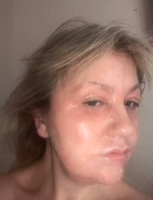 Amanda chia sẻ quá trình xóa nhăn mắt trên TikTok, nhắn nhủ với các chị em yêu làm đẹp rằng, muốn thực hiện liệu pháp trẻ hóa da này thì cần phải suy nghĩ kỹ.