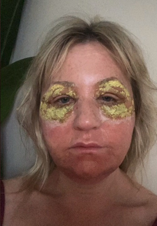 Amanda cho biết, cô đã sử dụng các sản phẩm hóa học axit để đốt bề mặt phần da nhăn nhúm. Mặc dù đây không phải là phương pháp điều trị xâm lấn nhưng thời gian phục hồi rất khó chịu.