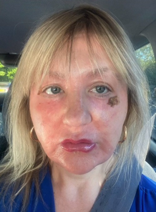 Sau khi các tổn thương mô phục hồi, Amanda vẫn có dấu hiệu bong tróc trên mặt, trông như thây ma. Cô cho biết: "Ngày đầu tiên tôi điều trị, cảm giác thực sự rất sợ. Da tôi bỏng rát, cơn đau kéo dài trong 12 giờ. Dù có người trợ lý đã sử dụng quạt điện để giúp hạ nhiệt trong quá trình điều trị nhưng nó hoàn toàn không hiệu quả".